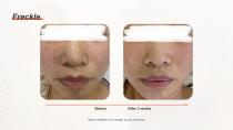 DPL PLUS Hair Removal + Filter DPL Skin Care-18