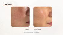 DPL PLUS Hair Removal + Filter DPL Skin Care-19