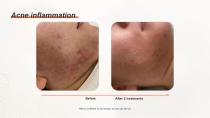 DPL PLUS Hair Removal + Filter DPL Skin Care-20