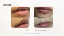 DPL PLUS Hair Removal + Filter DPL Skin Care-21