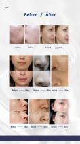 Portable Hydrafacial-7