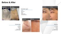 Vacuum microneedle RF machine PINXEL-VS-13