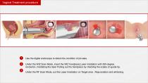 Vertical Fractional CO2 Laser-13