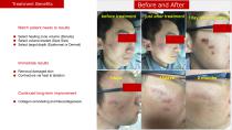 Vertical Fractional CO2 Laser-7