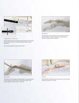 ®CrossTIE®PIP Arthrodesis Implant-3