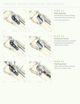 LAPIDUS IMPLANT SYSTEM-6
