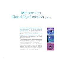 Dry-eye syndrome treatment using intense pulsed light technology-4