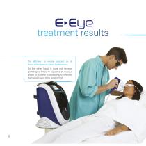 Dry-eye syndrome treatment using intense pulsed light technology-8