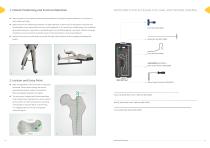 Neon Proximal Femoral Nail Surgical Technique-9