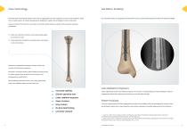 Nite Tibial Intramedullary Nail Surgical Technique-5