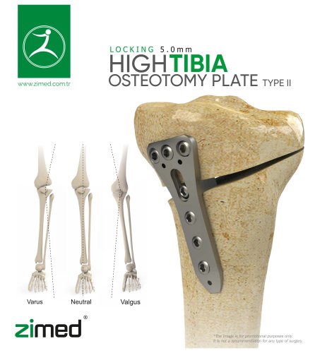 High Tibia Osteotomy Plate Type 2