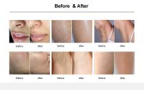 808nm Diode Laser Hair Removal Systems for Permanent Hair Reduction HairCore A-5