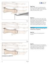 Exact Osteotomy System SURGICAL TECHNIQUE - 8