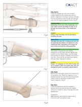 Exact Osteotomy System SURGICAL TECHNIQUE - 9