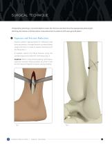 STRAIGHT FIBULA PLATING SYSTEM SURGICAL TECHNIQUE - 6