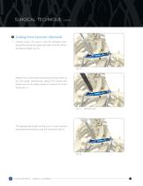 SUPERIOR CLAVICLE PLATING SYSTEM SURGICAL TECHNIQUE-9