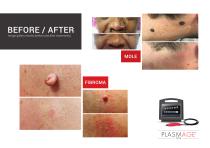 Plasmage SYSTEM - FDA USA-6