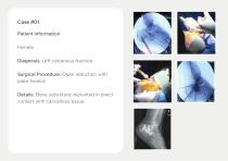 Bone Grafts – Portfolio-7