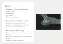 Bone Grafts – Portfolio-8
