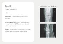 Bone Grafts – Portfolio-9