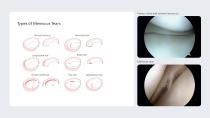 Precision MR® Suturing Device-3