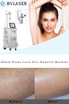 The best professional laser hair removal machine brand-BVLASER. 808nm diode laser hair removal machine.-1