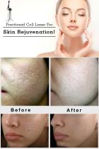 CO2 fractional laser machine manufacturer-BVLASER. OEM/ODM dermatology CO2 laser machine. The best CO2 laser skin resurfacing machine for sale.-1