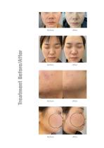 CO2 Fractional laser Scar removal skin rejuvenation machine Z-CO-60-6