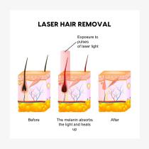 Diode laser Double handle Z-V-DAW-5