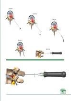 Discectomy-4