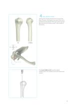 humerus InSafeLOCK Nail-7