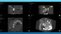 SAFETY SURGICAL HAMMER IN CLOSED SINUS ELEVATION-27