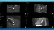 SAFETY SURGICAL HAMMER IN CLOSED SINUS ELEVATION-28