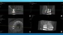 SAFETY SURGICAL HAMMER IN CLOSED SINUS ELEVATION-58