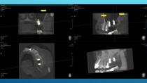 SAFETY SURGICAL HAMMER IN CLOSED SINUS ELEVATION-61