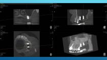 SAFETY SURGICAL HAMMER IN CLOSED SINUS ELEVATION-62