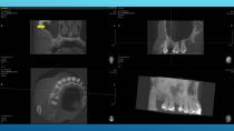 SAFETY SURGICAL HAMMER IN CLOSED SINUS ELEVATION-65