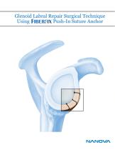 Glenoid Labral Repair Surgical Technique Using Push-In Suture Anchor-1