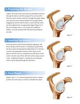Glenoid Labral Repair Surgical Technique Using Push-In Suture Anchor-3