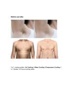 2024 Hair removal laser ice titanium-6