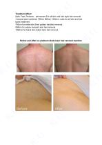 Medical Diode Laser Hair Removal Machine 1000W 1200W 1800W-4