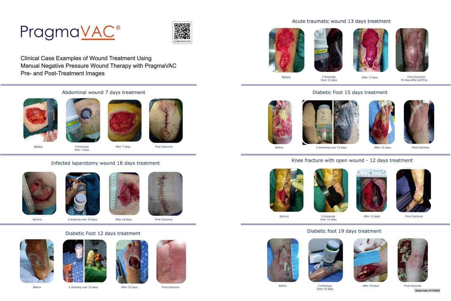 PragmaVAC&reg; Wound Treatment Case Examples - PragmaVAC