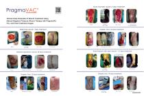PragmaVAC® Wound Treatment Case Examples-1