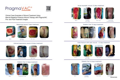 PragmaVAC® Wound Treatment Case Examples