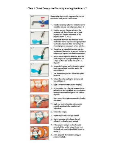 Class II Direct Composite Technique using ReelMatrix&trade;