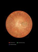 Retinal camera wide field -10