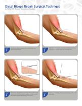 Distal Biceps Repair AcTiFlip SB Biceps Tenodesis System-2