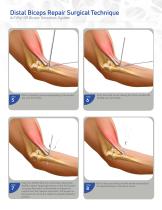 Distal Biceps Repair AcTiFlip SB Biceps Tenodesis System-3