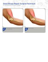 Distal Biceps Repair AcTiFlip SB Biceps Tenodesis System-4