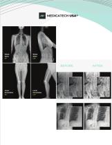 FULL SPINE AND LONG BONE DETECTOR-5